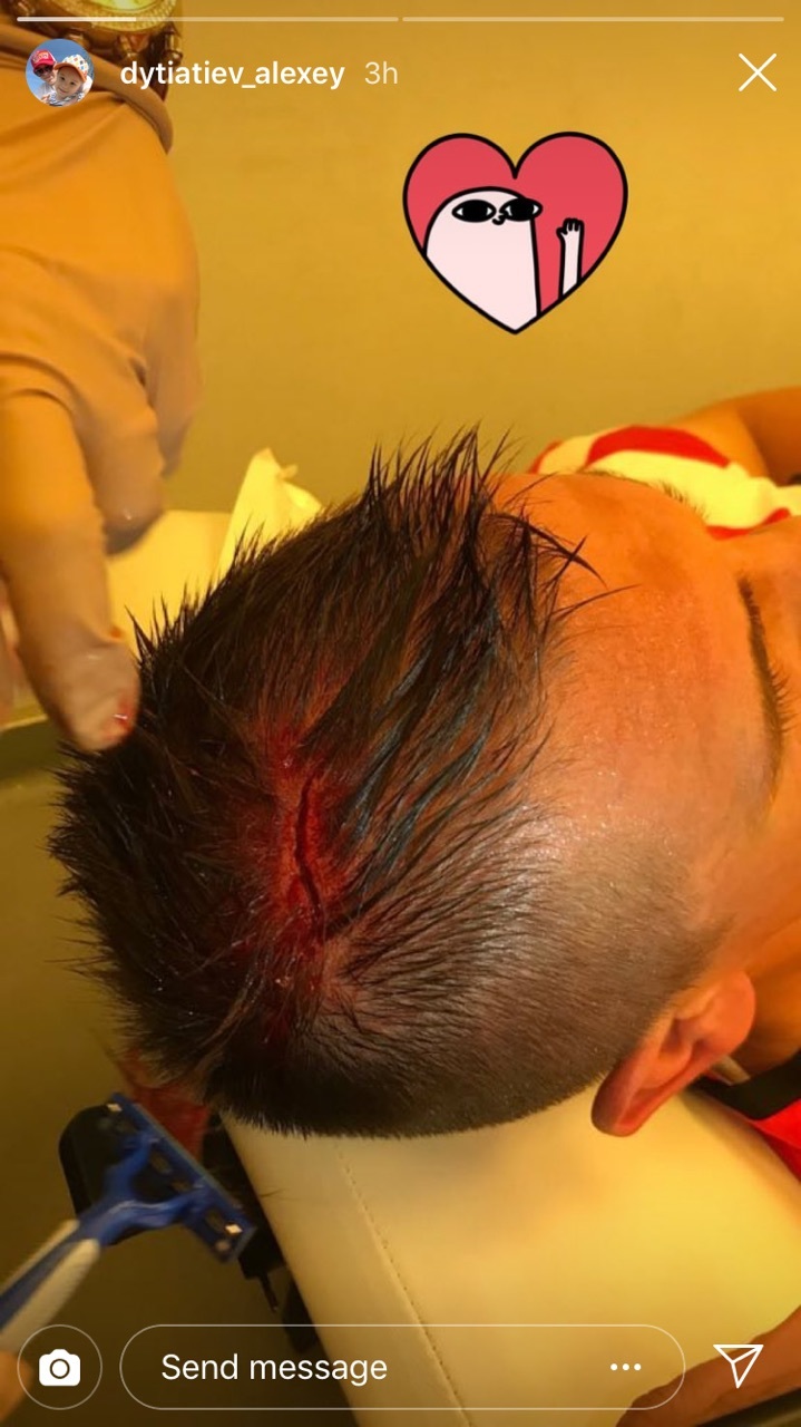 Украинцы в Польше: Алексею Дитятьеву зашивали голову после матча с "Гурником" (Фото) - изображение 1
