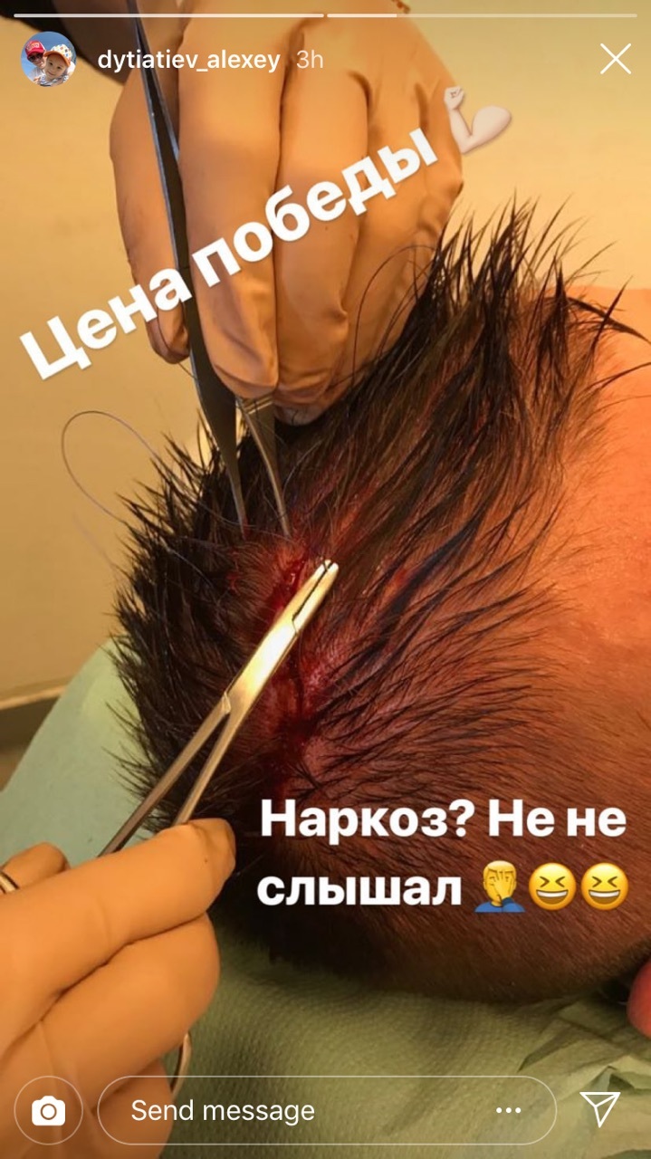 Украинцы в Польше: Алексею Дитятьеву зашивали голову после матча с "Гурником" (Фото) - изображение 2