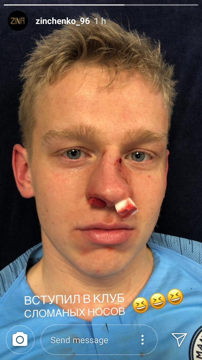 Фото дня: Александр Зинченко показал окровавленный и сломанный нос после удара Фернандиньо - изображение 1
