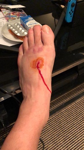 Лукас Перес показал ужасное повреждение в матче с "Кристал Пэлас" (Фото) - изображение 3
