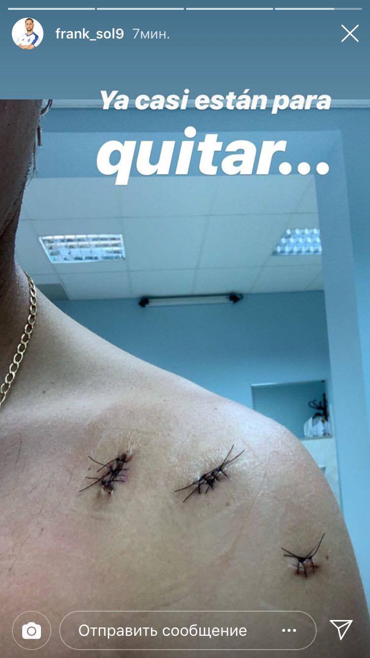 Швы на плече Франа Соля после операции (Фото) - изображение 1