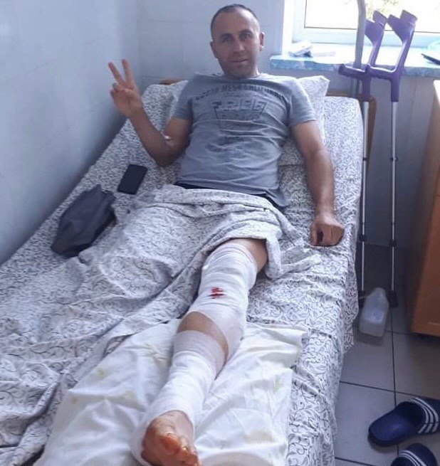 Тренер "Вереса" Микола Лапко зламав дві кістки. Його прооперували - изображение 1