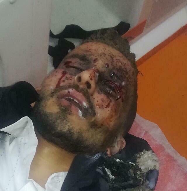 Защитник "Галатасарая" Омар Эль-Абделлауи получил травму глаза, пытаясь запустить фейерверк  (Фото) - изображение 1